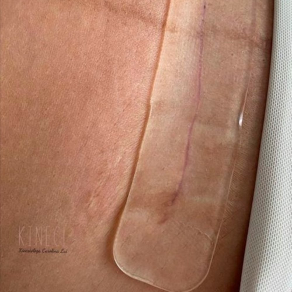 Lámina de silicona para cicatriz de cesárea - Motherna