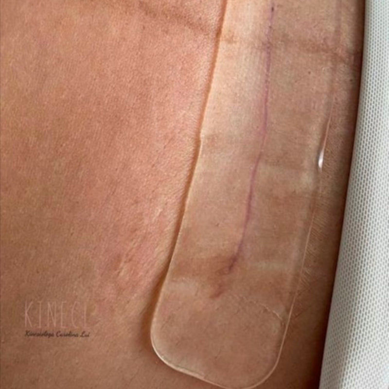 Lámina de silicona para cicatriz de cesárea - Motherna